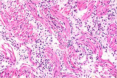 A holstein heifer infected with Neospora caninum NcUru3 congenitally transmits this strain to a viable offspring although infection does not protect her from aborting by a different N. caninum genotype in the subsequent gestation